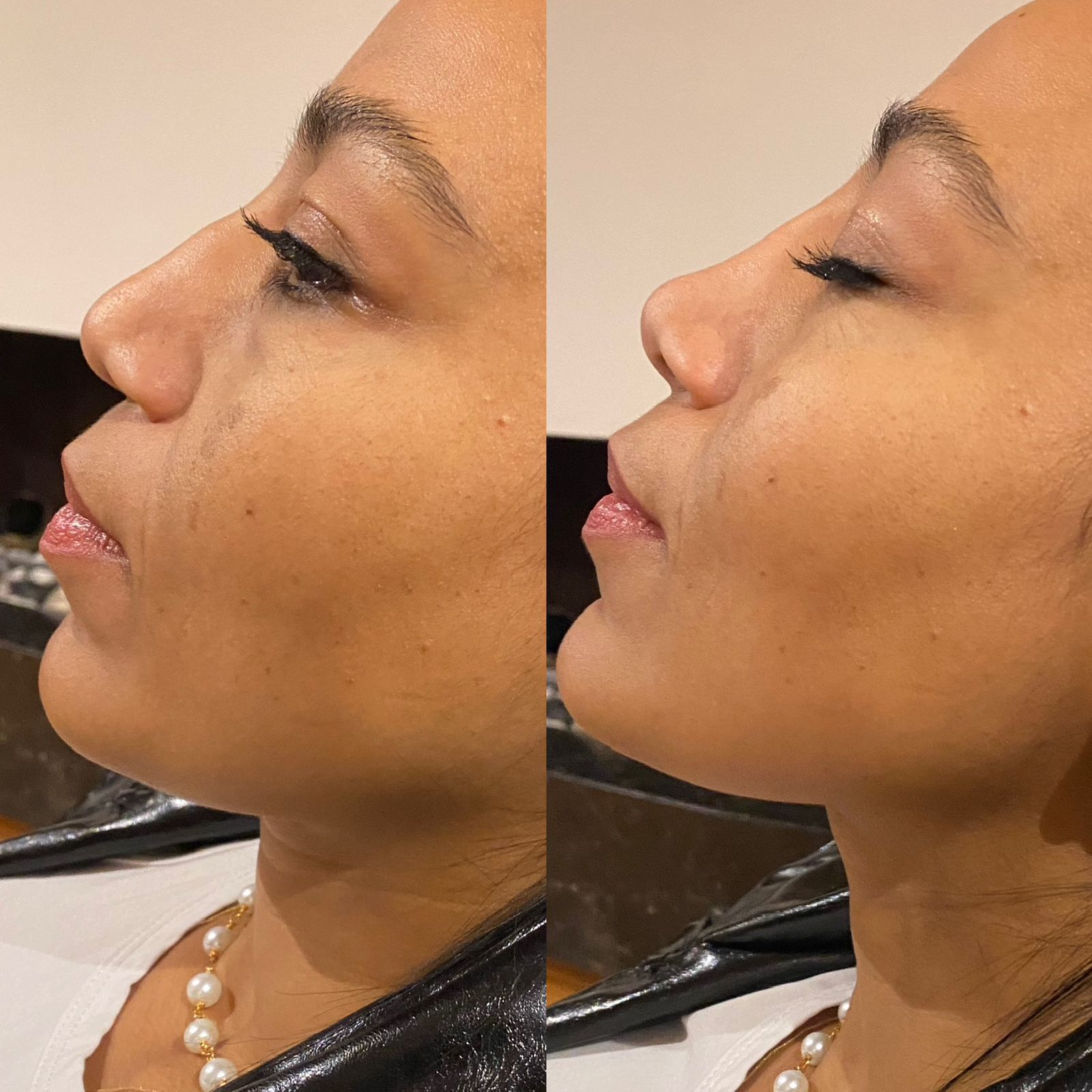 armonizacion-facial-bogota-2